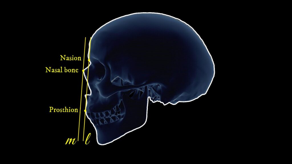 Line m drawn parallel to line l, passing through the foremost point of the nasal bone.