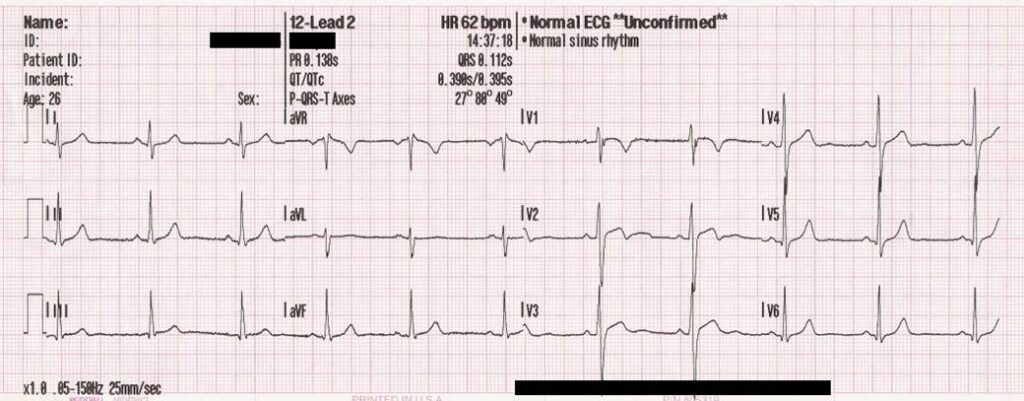 12-lead ECG of a 26-year-old male, printed on paper.