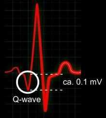 ECG showing a healthy Q wave as a small downward deflection in the heart’s electrical signal.